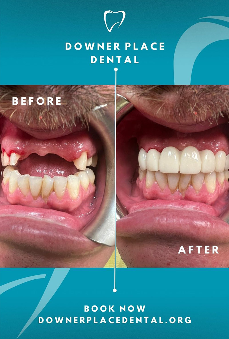Before and After