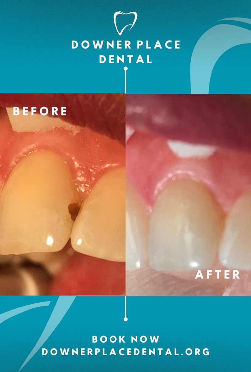 Before and After