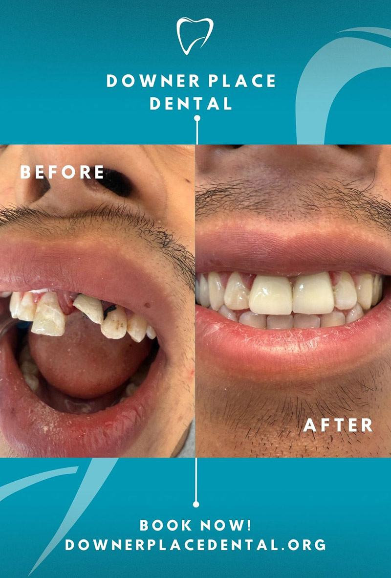 Before and After
