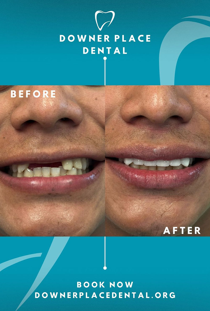 Before and After