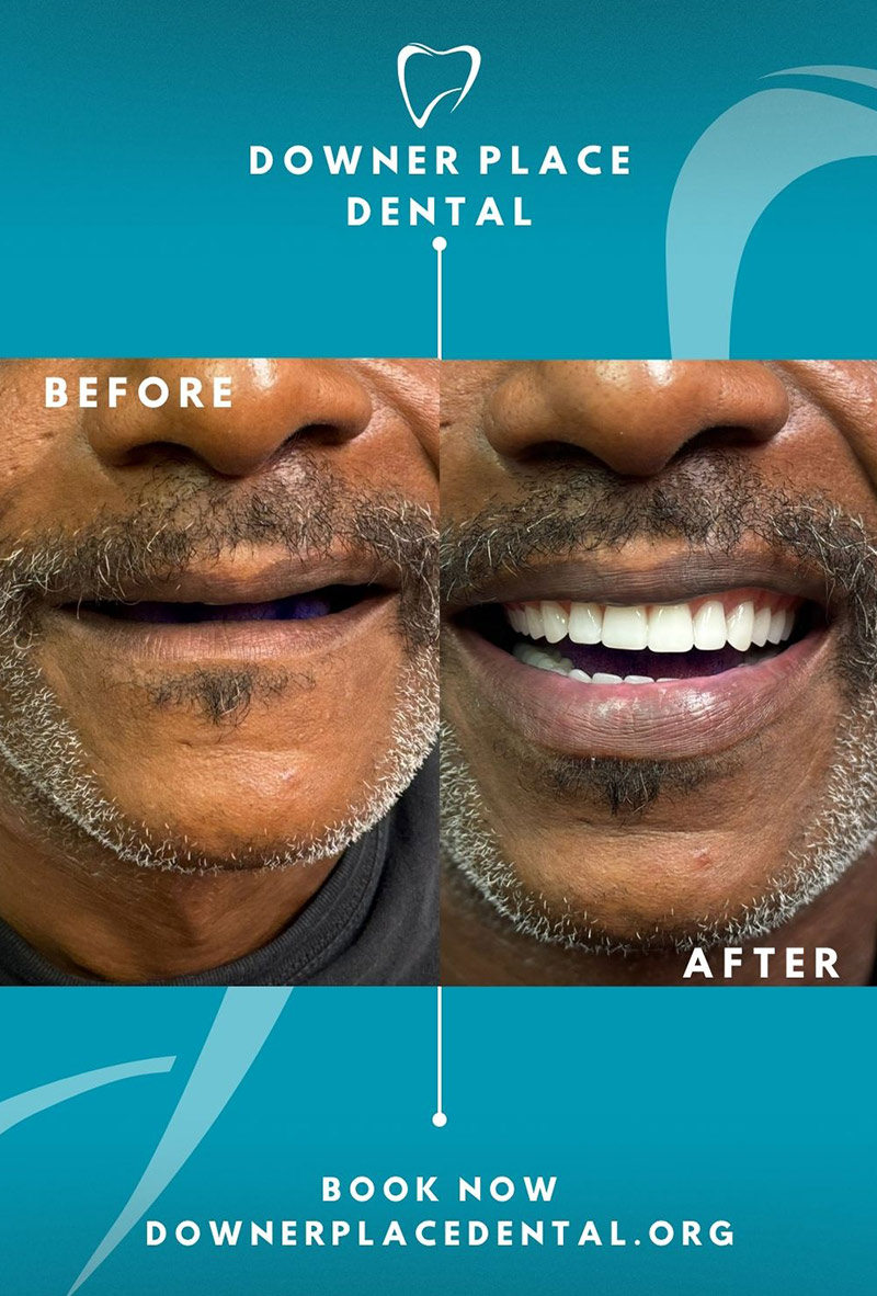 Before and After