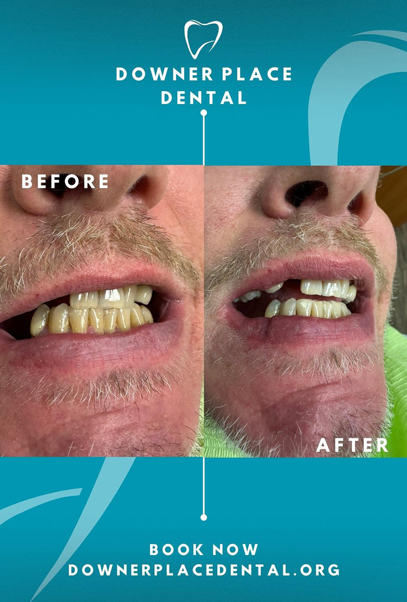 Before and After