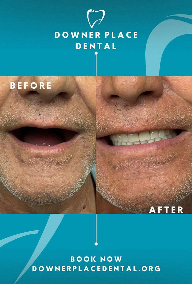 Before and After