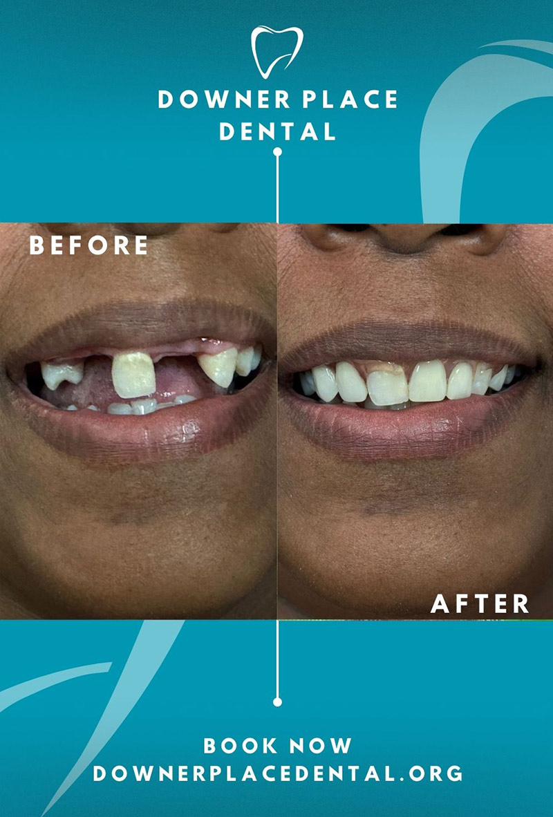 Before and After